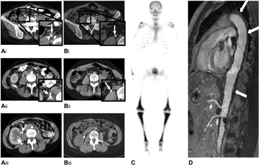 Figure 1. Radiologic findings in patients 1 and 2. Abdominal computed axial tomography scan of patient 1, before (A) and after (B) anakinra. Before starting anakinra, a soft tissue mass was observed surrounding the right ureter (white arrow; A1, A2). Image A3 shows the dilatation of the right renal cavities (white arrow), which required the insertion of a JJ-ureteric catheter (white arrowhead). After 6 months of anakinra treatment, the retroperitoneal fibrosis surrounding the right JJ-catheter had disappeared (B1, B2; white arrow), and the kidney pyelo-ureteral cavities had returned to their normal sizes. (C) A 99m technetium-Methyl diphosphonate bone scan of patient 2 shows symmetrically increased uptake in the diaphyses and metaphyses of the femurs and tibias. (D) Magnetic resonance angiography of the aorta of patient 2 shows periaortic fibrosis (white arrow) with a coated aorta appearance.