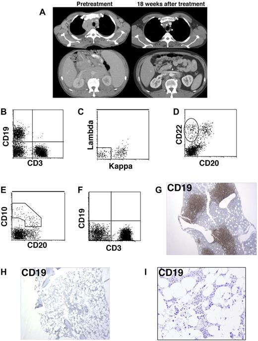 Figure 1. B-lineage cells, including B-cell precursors, were eradicated from the bone marrow after treatment with anti–CD19-CAR-transduced T cells. (A) Representative pretreatment computed tomography scan images and images from 18 weeks after treatment demonstrate regression of lymphoma masses in the chest and abdomen after treatment with chemotherapy followed by anti–CD19-CAR-transduced T cells plus IL-2. (B) Flow cytometric evaluation of a pretreatment bone marrow aspirate was conducted with a forward versus side light scatter analysis gate of lymphoid cells. The left upper quadrant contains CD19+ B-lineage cells (35% of lymphoid cells), and the right lower quadrant contains CD3+ T cells. (C) Flow cytometric evaluation of a pretreatment bone marrow aspirate with a CD19+ analysis gate is shown. κ- and λ-negative, CD19+, mostly immature B-lineage cells that are not part of the malignant lymphoma clone are in the rectangle. The cells outside the rectangle are mostly lymphoma cells. (D) Flow cytometric evaluation of a pretreatment bone marrow aspirate with a forward versus side light scatter analysis gate of lymphoid cells. Immature B-cell precursors in the oval are CD22+ and CD20−. (E) Flow cytometric evaluation of a pretreatment bone marrow aspirate with a forward versus side light scatter analysis gate of lymphoid cells. Immature B-cell precursors in the polyhedral demonstrate decreasing CD10 correlating with increasing CD20 expression. (F) Flow cytometric evaluation of a bone marrow aspirate from 36 weeks after treatment with a forward versus side light scatter analysis gate of lymphoid cells. CD19+ B-lineage cells are absent. (G) Immunohistochemistry staining of a pretreatment bone marrow biopsy reveals a large population of CD19+ cells that includes lymphoma cells as well as nonmalignant B-lineage cells. (H) Immunohistochemistry staining of a bone marrow biopsy from 36 weeks after infusion of anti–CD19-CAR-transduced T cells demonstrates a complete absence of CD19+ cells. (I) High-power view of the same anti-CD19 staining shown in panel H.