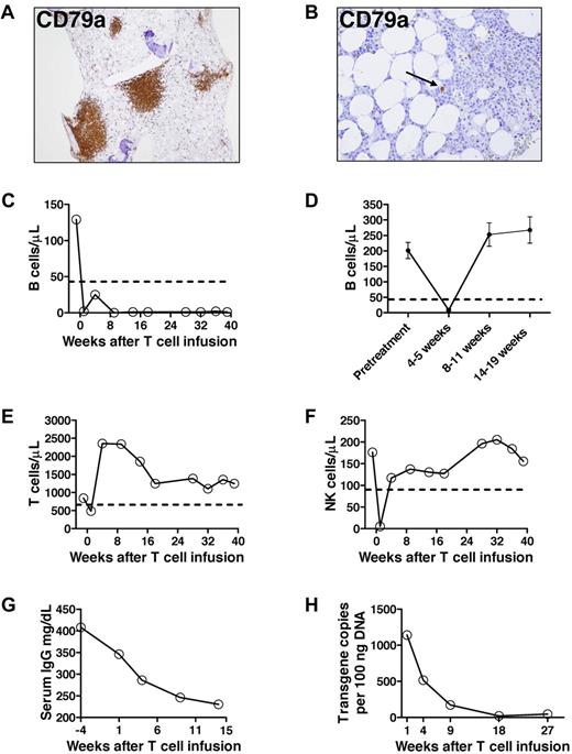 Figure 2. Prolonged B-cell depletion after anti–CD19-CAR-transduced T-cell infusion. (A) Immunohistochemistry staining of a pretreatment bone marrow biopsy shows a large population of CD79a+ cells. (B) Thirty-six weeks after anti–CD19-CAR-transduced T-cell infusion, rare CD79a+ cells were detected by immunohistochemisty staining of a bone marrow biopsy. The cells did not appear to be plasma cells morphologically. The number of CD79a+ cells was substantially below normal limits. The arrow indicates one of the rare CD79a+ cells. (C) The blood B-cell count of the patient treated with anti–CD19-CAR-transduced T cells is shown before treatment and at multiple time points after treatment. B cells were measured by flow cytometry for CD19. The dashed line indicates the lower limit of normal. Day 0 is the day of the second anti–CD19-CAR-transduced T-cell infusion. (D) The mean ± SEM blood B-cell count is shown for patients who received infusions of T cells targeted to either the NY-ESO antigen or the gp100 antigen. The patients all received the same chemotherapy and IL-2 regimen as the patient who received anti–CD19-CAR-transduced T cells. NY-ESO and gp100 are not expressed by B cells. Day 0 is the day of T-cell infusion. All available B-cell counts were included for each time point (pretreatment, n = 28; 4-5 weeks after T-cell infusion, n = 29; 8-11 weeks after T-cell infusion, n = 31; 14-19 weeks after T-cell infusion, n = 20). All patients with available samples had a B-cell count in the normal range by 14 to 19 weeks after T-cell infusion. (E) The blood CD3+ T-cell count of the patient treated with anti–CD19-CAR-transduced T cells is shown before treatment and at multiple time points after treatment. (F) The blood NK cell count of the patient treated with anti–CD19-CAR-transduced T cells is shown before treatment and at multiple time points after treatment. NK cells were measured by flow cytometry as CD3−, CD16+, CD56+ cells. (E-F) Day 0 is the day of the second anti–CD19-CAR-transduced T-cell infusion, and the dashed line indicates the lower limit of normal. (G) The serum IgG level of the patient treated with anti–CD19-CAR-transduced T cells is shown before treatment and at multiple time points after treatment. Day 0 is the day of the second anti–CD19-CAR-transduced T-cell infusion. (H) Real-time polymerase chain reaction was performed with a primer and probe set that was specific for the anti-CD19 CAR. Anti–CD19-CAR-transduced T cells were undetectable in pretreatment blood samples. The anti–CD19 CAR transgene was detected in the peripheral blood of the patient who received anti–CD19-CAR-transduced T cells from 1 to 27 weeks after anti–CD19-CAR-transduced T-cell infusion.