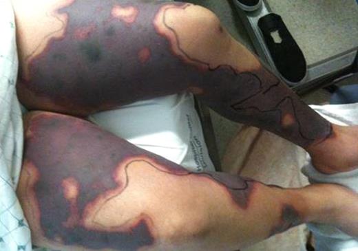 Figure 1. Palpable purpuric plaques on bilateral lower extremities.