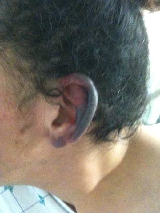 Figure 2. Necrotic ear helix.