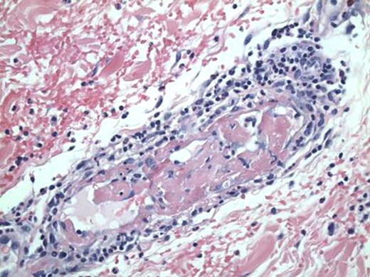 Figure 3. Skin biopsy showing small vessel thrombovasculopathy, organizing thrombus and mixed cell infiltrate.