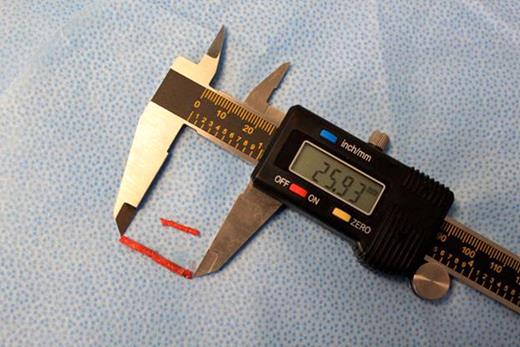 Figure 1. Demonstrates bone marrow core samples obtained from one subject using Manual biopsy device (upper sample) and Powered biopsy device (lower sample).