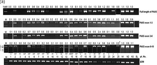 Figure 1. RT-PCR analysis of PAX5 mRNA. (a) The PAX5 expression level was normalized to that of the internal control beta-2 microglobulin. The PAX5 expression is displayed as a relative ratio to the average PAX5 expression in normal mature B cells.