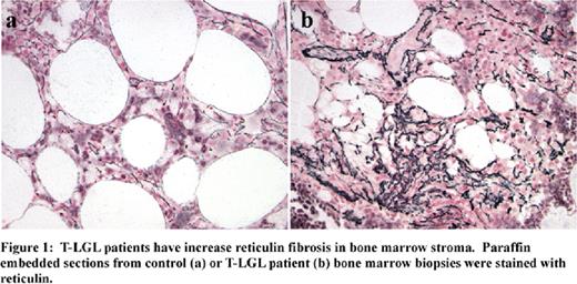 Figure 1:. T-LGL patients have increase reticulin fibrosis in bone marrow stroma. Paraffin embeddeb from control (a) or T-LGL patient (b) bone marrow biopsies with reticulin.