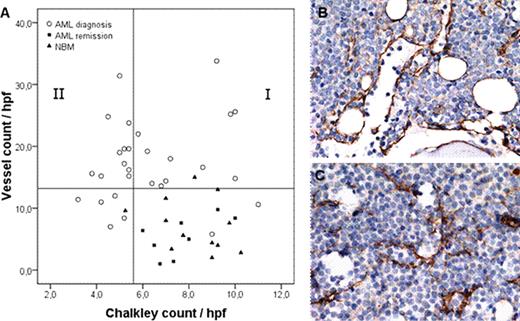 Fig.1. Morphology patterns in AML bone marrow biopsies. (A) Scatterplot representing the bone marrow vessel count and Chalkley count of AML at diagnosis, NBM and AML at remission. AML biopsies at diagnosis with a ‘low vessel count’ are displayed below the Y-axis reference line (13 microvessels/hpf), based on the fact that >95% of NBM and AML remission had a vessel count below 13 microvessels/hpf. The X-axis reference line divides AML biopsies at diagnosis with a ‘high vessel count' into two groups according to median Chalkley count of 5.4 in AML at diagnosis. The >95% Chalkley count of the NBM and AML remission biopsies sets an identical cut-off point. Group I, ‘vessel hyperplasia'>5.4; group II, ‘angiogenic sprouting' ≤5.4. Spearman's rho 0.15, p=0.42. (B) Representative picture of immunohistochemical staining for ‘vessel hyperplasia' and (C) ‘angiogenic sprouting'.