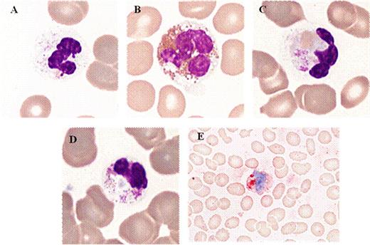 Figure 1:. Typical morphological features in patients with ider(20q) (peripheral blood).