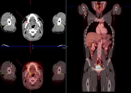 Figure 1. Restaging PET scan showing increased FDG tonsil uptake (red arrows) in a 38-year-old male patient with Hodgkin's disease stage II status post ABVD chemotherapy. Tonsillectomy was negative for malignancy.