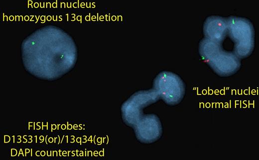 Figure 1. Round Cell with FISH Detectable 13q- vs Lobed Cells without FISH Detectable Defect