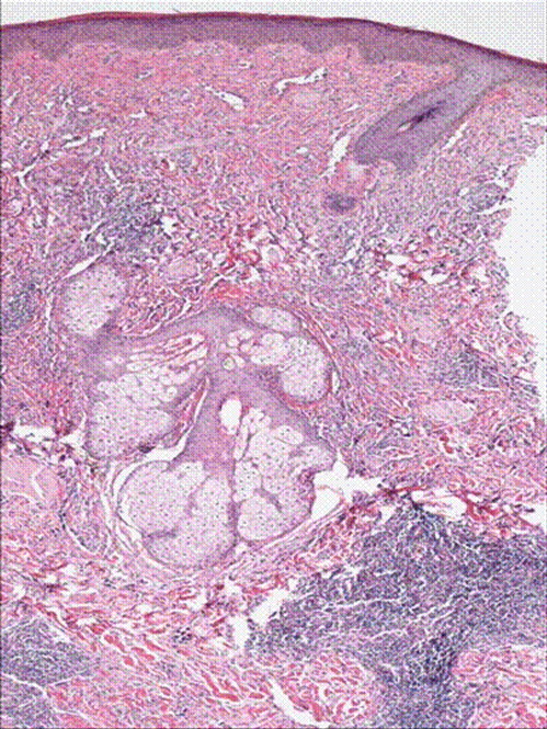 Figure 1. H& E stain of punch biopsy of the lesion from the cheek showing infilterating vascular tumor.