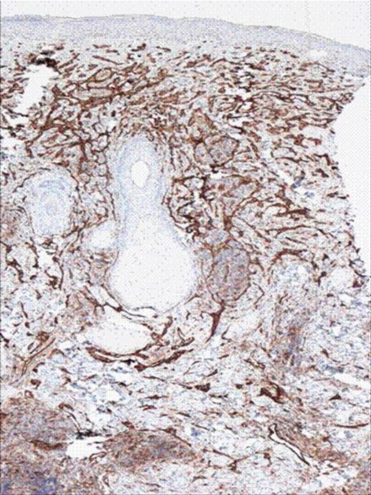 Figure 2. CD 31 stains of the skin biopsy showing vascular tumor.