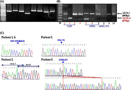 Figure 1. Molecular studies of the GATA1 gene. The GATA1 gene was amplified using gDNA and cDNA genomic DNA and cDNA. (A) PCR amplified products of GATA1 gene using 8 overlapping primer sets. (B) RT-PCR amplified products of exon 2 of GATA1, GATA1 mRNA (400 bp), and GATA1s mRNA (172bp) are shown. (C) Reverse partial chromatogram of GATA1 gene in exon 2. Direct sequencing data showed GATA1 mutations from 109–110 del AG in exon 2 in patient 1 with TAM and patient 6 with AMKL, 1–239del239bp in patient 2 with TAM, 20A>G in patient 3 with TAM, and 193ins19bp in patient 5 with AMKL.