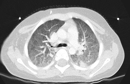 Figure 1. Ground Glass Opacities on CT Chest