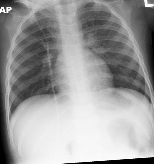 Figure 2. Chest x-ray infiltrates