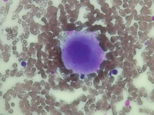Figure (1). Bone marrow aspirate smear demonstartes poorly differentiated hypolobulated megakaryocyte with disperse chromatin pattern