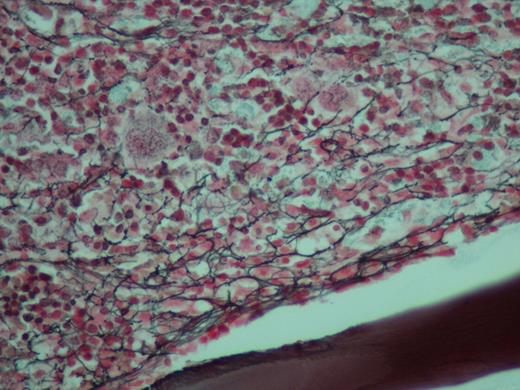 Figure (2). Reticulin stain of biopsy showing a moderate to marked increase in coarse reticulin fibers