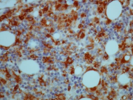 Figure (3). Immunohistochemical staining for CD68