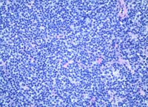 Photograph of left gluteal muscle prior to initiating chemotherapy.