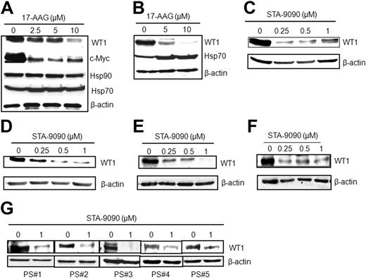 Figure 3. Pharmacologic inhibition of Hsp90 down-regulates WT1 protein. (A) K562 and (B) KG-1 leukemia cells were treated with the Hsp90 inhibitor 17-AAG for 24 hours. The cells were lysed, and protein extracts were subjected to SDS-PAGE and analyzed by Western blotting for WT1, Hsp90, and/or the WT1-regulated protein c-Myc. β-actin was used as loading control. (C) K562, (D) KG1, (E) Kasumi-1, and (F) MV4-11 leukemia cells were treated with the Hsp90 inhibitor STA-9090 for 24 hours and analyzed for WT1 expression by Western blotting. (G) Primary myeloid leukemia blasts from 5 AML patients (PS#1-5) were isolated, treated with STA-9090 for 24 hours, and analyzed for WT1 and β-actin by Western blotting.