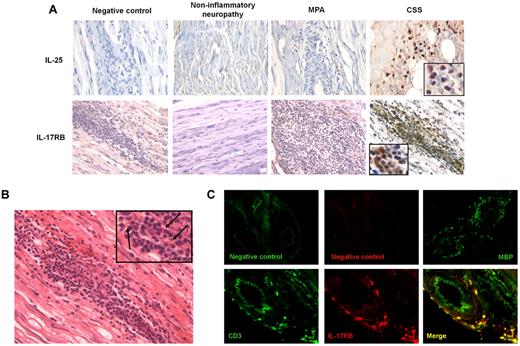 Figure 5. IL-17RB+ T cells and IL-25 are expressed in vasculitic lesions of CSS patients. (A) Immunohistochemical analyses of nerve tissue specimens from patients with CSS, MPA, and noninflammatory neuropathy. IL-25 and IL-17RB were expressed within the perivascular infiltrates in patients with CSS, compared with that in patients with MPA and those with noninflammatory idiopathic neuropathy (original magnification ×540; × 1080 for the inserts in CSS panels). (B) H&E staining. Mononuclear cells and eosinophils (black arrows) were observed within the perivascular inflammatory infiltrate (original magnification ×540; ×1080 for the insert). (C) Immunofluorescence microscopy analysis of frozen nerve tissue specimen from CSS patients revealed expression of the eosinophil granule Major Basic Protein (MBP) and colocalization of IL-17RB with CD3 within the perivascular infiltrates, indicating that infiltrating IL-17RB–expressing cells were T cells (original magnification ×270 for negative control and MBP; ×540 for CD3 and IL-17RB staining). Immunohistochemistry and immunofluorescence images were acquired using a Leica DMI6000B microscope (Leica) and analyzed using the Metaview software.