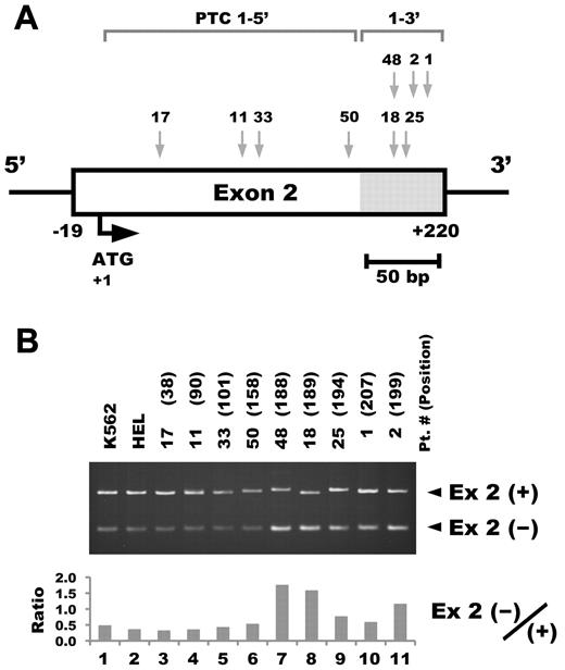 Figure 3. The location of the PTC type 1 mutation affects the efficiency of alternative splicing in TAM blast cells. (A) The location of the GATA1 mutation in each TAM patient. Details of the mutation in each sample are described in Table 1. (B) RT-PCR analysis of GATA1 in TAM blast cells harboring PTC type 1 mutations. RT-PCR was performed using primers recognizing both the long transcript including exon 2 and Δexon 2 (top). All of the patient samples consisted of mononuclear cells from peripheral blood. The numbers in parentheses indicate the number of nucleotides in mRNA from the translation initiation codon. Ex 2(+) and Ex 2(−) indicate PCR products with or without exon 2, respectively (middle). Ratio of Ex 2(−)/(+) was calculated from the results of a densitometric analysis of the RT-PCR (bottom). Note that the intense bands of the short form were observed in the samples from the patients who have GATA1 mutations located on the 3′ side of exon 2 (lanes 7-11).