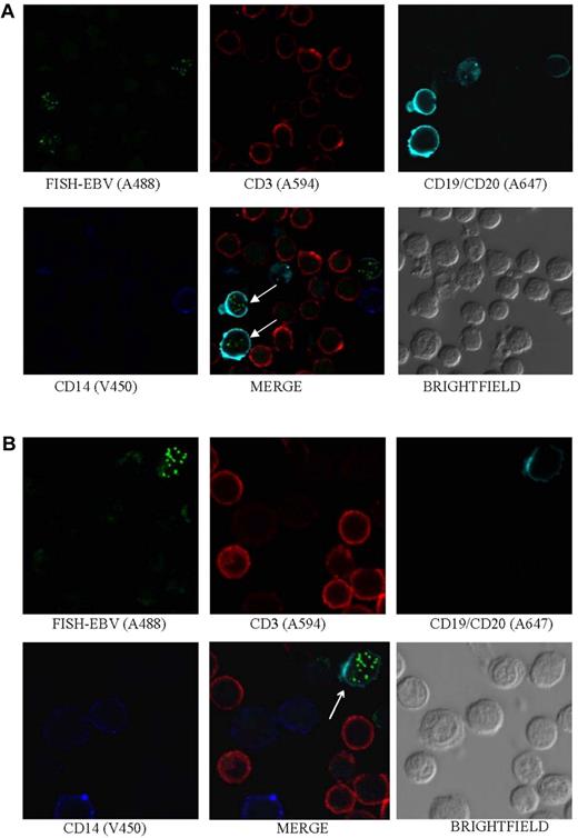 Figure 1. EBV is detected in B cells. Photomicrographs of PBMCs stained by Immuno-FISH from patients 17 (A) and 8 (B) show EBV in the nucleus of B cells (arrows). EBV DNA was identified with the biotinylated FISH probe and streptavidin-conjugated Alexa 488, B cells using a combination of Alexa 647–conjugated anti-CD19 and anti-CD20 antibodies (Biolegend), T cells with Alexa 594–conjugated anti-CD3 antibody (Invitrogen), and monocytes with V450-conjugated anti-CD14 antibody (BD Biosciences). Arrows indicate EBV-positive cells.