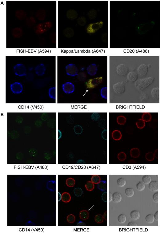 Figure 3. EBV is detected in plasmablasts/plasma cells and T cells. (A) Photomicrographs of PBMCs stained by Immuno-FISH from patient 4 shows EBV in plasmablasts/plasma cells identified using Alexa 647–conjugated anti-κ and anti-λ chain immunoglobulin antibodies. The EBV-positive cells are negative for CD20 using Alexa 488–conjugated anti-CD20 antibody. EBV DNA was identified with the biotinylated FISH probe and streptavidin-conjugated Alexa 594 and monocytes with V450-conjugated anti-CD14 antibody. Although most of the EBV DNA was detected in the nucleus, some viral DNA was detected in the cytoplasm, suggesting that EBV lytic infection was present in the cell. (B) Photomicrographs of PBMCs stained by Immuno-FISH from patient 12 shows EBV in CD3+ T cells. EBV DNA was identified with biotinylated FISH probe and streptavidin-conjugated Alexa 488, B cells using a combination of Alexa 647–conjugated anti-CD19 and anti-CD20 antibodies, T cells with Alexa 594–conjugated anti-CD3 antibody, and monocytes with V450-conjugated anti-CD14 antibody. Arrows indicate EBV-positive cells.