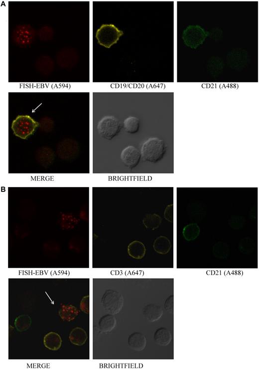 Figure 4. EBV is detected in CD21+ B cells and in CD21− T cells.(A) Photomicrographs of PBMCs stained by Immuno-FISH from patient 12. EBV is detected in B cells that are CD21+. (B) EBV is detected in CD3+ T cells that do not express CD21. EBV DNA was identified with the biotinylated FISH probe and streptavidin-conjugated Alexa 594, B cells using a combination of Alexa 647–conjugated anti-CD19 and anti-CD20 antibodies, T cells with Alexa 647–conjugated anti-CD3 antibody, and CD21 with Alexa 488–conjugated anti-CD21 antibody. Arrows indicate EBV-positive cells.