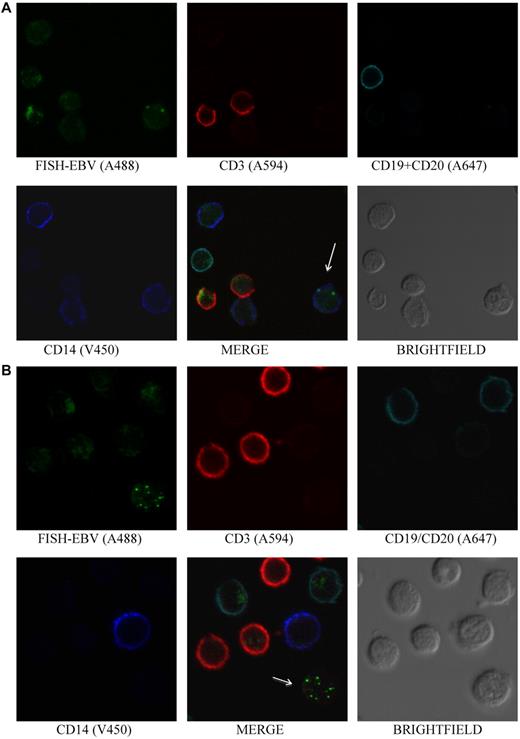 Figure 5. EBV is detected in monocytes and in non-B, non-T, and non-monocyte cells. (A) PBMCs stained by Immuno-FISH from patient 5 shows EBV in monocytes. EBV DNA was identified with the biotinylated FISH probe and streptavidin-conjugated Alexa 488, T cells using Alexa 594–conjugated anti-CD3, B cells using a combination of Alexa 647–conjugated anti-CD19 and anti-CD20 antibodies, and monocytes with V450-conjugated anti-CD14 antibody. Arrow indicates EBV-positive cell. (B) PBMCs stained by Immuno-FISH from patient 6 shows EBV in non-B, non-T, and non-monocyte cells. Arrow indicates EBV-positive cell.