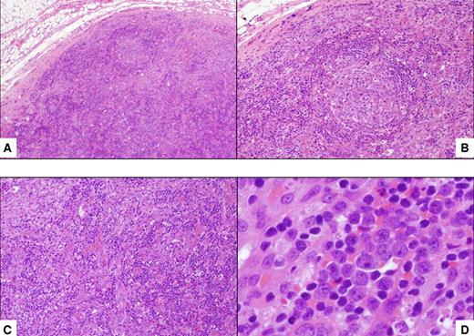 Figure 1. Histopathologic features of HIV MCD. (A) Lymph node shows a small follicle with relatively atrophic germinal center and mildly expanded mantle zone. The tissue outside the follicle (interfollicular area) is rich in vessels and plasma cells (hematoxylin and eosin; original magnification ×40). (B) Higher magnification of the follicle, including the mantle zone (hematoxylin and eosin; original magnification ×100). (C) Higher magnification of the interfollicular area (hematoxylin and eosin; original magnification ×100). (D) Within the mantle zone, there are several large cells with nucleoli, the so-called “plasmablasts” (hematoxylin and eosin; original magnification ×600).