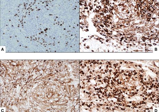 Figure 2. Immunocytochemical features of HIV MCD plasmablasts. (A) On immunohistochemistry, the large lymphoid cells with nucleoli, the so-called “plasmablasts,” harbor HHV8 virus as demonstrated by the presence of HHV8–latent nuclear antigen-1. The cells express IgM (B) and lambda light chain (D) and are negative for kappa light chain (C). All original magnifications are ×600.
