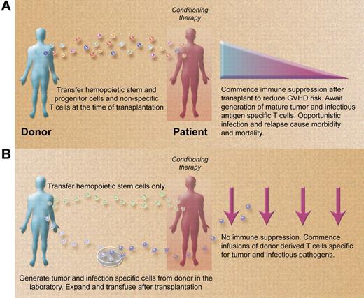 Paradigms for allogeneic stem cell transplantation (A) presently and (B) in the future. (A) Stem cell transplantations are performed with grafts containing stem and progenitor hemopoietic cells and nonspecific donor T cells. Posttransplant immune suppression required to control GVHD promotes opportunistic infection and disease relapse. (B) Stem cell transplantations are performed with grafts containing large numbers of purified stem cells depleted of nonspecific donor T cells. Posttransplant infusions of infection and malignancy specific T cells rapidly reconstitute the immune system in the absence of immune suppression, reducing the risk of opportunistic infection and disease recurrence. (Professional illustration by Alice Y. Chen.)