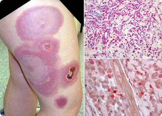A 12-year-old boy with Fanconi anemia presented with a 3-week history of painless, circular, bluish skin lesions, up to 15 cm in diameter, most prominently seen on the lateral portions of his right upper leg (see figure, top left). He was afebrile with anemia (Hb 90 g/L) and thrombocytopenia (platelets 45 × 103/μL), but a normal leukocyte count. There were no blasts in the peripheral blood smear. / A skin biopsy showed an infiltration with myelomonocytic, POX-positive and NACE-positive blast cells, compatible with acute myelogenous leukemia (AML), French-American-British (FAB) subtype M4 (see figure, right). The bone marrow was hypocellular without evidence of acute leukemia. Treatment resulted in a complete remission, but the patient died with disseminated adenovirus following an allogeneic bone marrow transplantation. / Bone marrow failure and acute leukemia are well-known complications of Fanconi anemia. Extramedullary manifestations of AML may be observed in some subtypes of AML, most commonly FAB M2, but are infrequent in Fanconi anemia.