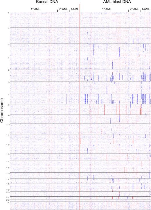 Figure 1. Whole genome copy number heatmap display of 114 AML genomes: Copy number heatmap displays for paired DNA samples based on SNP 6.0 array profiling were generated using dChipSNP. (Left panel) Buccal DNA. (Right panel) AML blast DNA. Samples are grouped by AML subtype (primary, secondary, and treatment-related) and by chromosome number (1-22 and X). Blue indicates copy loss, red indicates copy gain. Each column represents one patient.