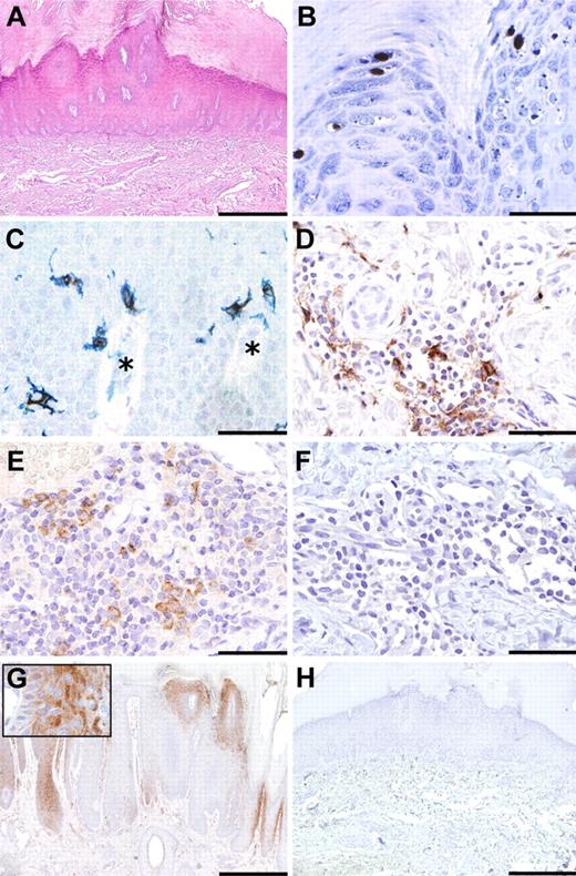 Figure 2. DCs in Verruca vulgaris. Sections of Verruca vulgaris were obtained from a WHIM patient (A-D,F,H) and a control case (E,G) and stained for hematoxylin and eosin (A), HPV (brown, B), CD1a (blue in C; and brown D), CD207 (brown, C), BDCA2 (brown, E-F), and MxA (brown, G-H). Verruca vulgaris from WHIM patient 4 showed a moderate dermal mononuclear infiltrate (A) and contained HPV-infected keratinocytes (B). By immunohistochemistry, intraepidermal CD1a+CD207+ Langerhans cells (C) and dermal CD1a+ cells (D) were detected in WHIM patient biopsy. *Position of dermal papillae. Dermal BDCA2+ cells were detectable in control cases (E) but not seen in the patient biopsy (F). Strong reactivity for MxA was observed in keratinocytes from a control biopsy (G and inset), whereas it was completely negative in WHIM patient biopsy (H). Original magnifications are as follows: A,G-H, ×40 (scale bar represents 500 μm); B, ×600 (scale bar represents 20 μm); and C-F, inset in G, ×400 (scale bar represents 50 μm).