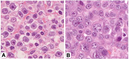 Figure 1. Cytomorphology of immunoblastic lymphoma. (A) IB lymphoma predominantly harboring large cells with abundant, deeply basophilic cytoplasm, large vesicular nuclei and a large central solitary nucleolus (100× objective, total magnification ×1000). (B) IB lymphoma with plasmablastic features. Note that the predominant cell is large, with abundant, basophilic cytoplasm and eccentric, round to oval nuclei differing in size and a solitary or several paracentric nucleoli (100× objective, total magnification ×1000). Images have been performed with a Zeiss Axiophot Microscope, a Jenoptik ProgRes CF camera, and the ProgRes CapturePro 2.6 software package for image processing (Jenoptik).