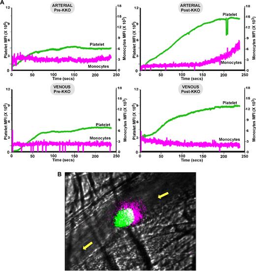 Figure 6. In situ laser injury studies in the murine HIT model. (A) Shown are cumulative information for platelets (green) and monocytes (pink) at a site of induced injury for ≥ 10 injuries per condition within the arterioles and venules and pre- and post-KKO as indicated. (B) Same as in panel A but still from video at 4 minutes from an arteriole injury showing the accumulation of CD115+-monocytes and/or microparticles at the upstream end of a growing thrombus. Platelets appear green, monocytes pink, and the overlap white. The yellow arrow denotes the direction of blood flow.