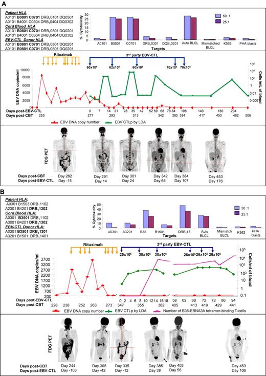 Figure 1. EBV-CTL administration timeline, EBV-specific CTL precursor (CTLp) blood levels, and the EBV-qPCR and FDG-PET disease course. (A) Patient #1. Top panel: T cells generated from the third-party donor were restricted by the B*0801 and C*0701 HLA-alleles presented on the EBV+ tumor of the patient and were EBV-specific. The HLA-typing of the engrafting unit is shown. The HLA-typing of the other unit was A*0101, A*0101; B*0801, B*2705; C*0701, C*0102; DRB1*0101, DRB1*0404; DQ*0501, DQ*0302. However, this unit did not engraft. Middle panel: EBV DNA increased on day 253 after CBT (red line) and partially responded to 10 doses of Rituximab. EBV viremia resolved completely after EBV-specific T-cell administration with partial clinical remission after 3 infusions and complete remission after 5 infusions. Peripheral blood EBV-specific CTLp measured by limiting dilution analysis (LDA) rose after each administration indicating transient in vivo expansion (green line) with subsequent decrease in frequencies after 10 days. Bottom panel: PET images demonstrating extensive abdominal and cervical lesions, persistence of abdominal and lesions as well as pulmonary lesions, marked resolution in abdominal lesions at 24 days, near resolution of abdominal and pulmonary lesions at 107 days, and complete remission 176 days after CTL initiation. (B) Patient #2. Top panel: The cytotoxic EBV-specific CTL activity was restricted by the HLA-B*3501 and DRB1*13 HLA-antigens shared with the CB donor. Middle panel: Increased EBV DNA was first detected in the blood 244 days after CBT (red line). This resolved after 7 doses of Rituximab. However, because of relapsed lymphoma in the intestine the patient received EBV-CTLs on day 347. LDA demonstrated 4-fold increase in EBV-CTLp frequency (green line) by day 7 that remained high until 18 days after the first CTL dose. The second course of 3 infusions resulted in a 10-fold increase of EBV-CTLp for another 30 days. T cells binding an HLA-B35-EBNA3A tetramer (purple line), which were the major class I restricted T cells in the T-cell adoptive therapy, were not detectable before CTL infusion, but increased 4-5 logs by 16 days after CTL initiation. Bottom panel: Extensive abdominal and cervical lymphoma 244 days after CBT largely resolved after the 8 doses of Rituximab (day +305). However, abdominal disease recurred that was successfully treated with EBV-CTLs that induced partial remission by 56 days and complete remission by 106 days after CTL initiation.