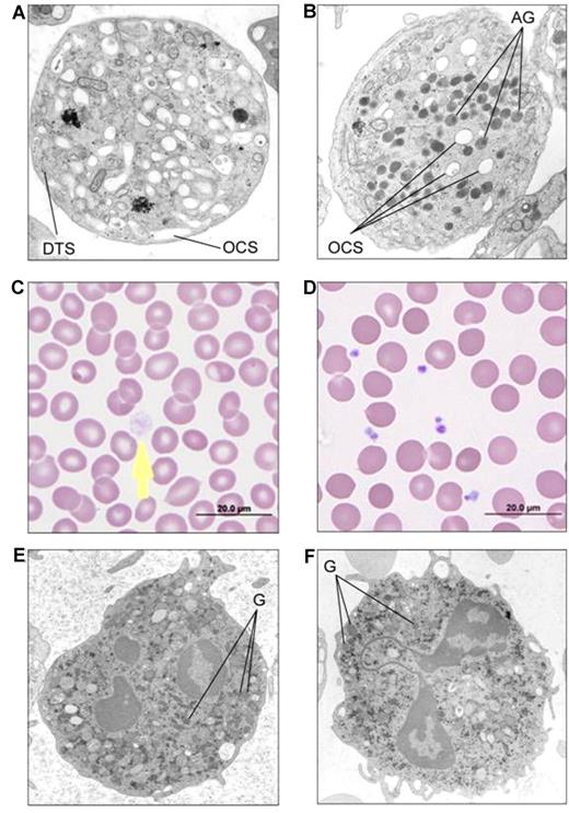 Figure 2. Platelet and neutrophil images of GPS patients in comparison with controls. (A) EM of thin sections of a platelet from patient 1(V-20) showing absence of α-granules and abundant channels of the open canalicular system (labeled as OCS) in comparison with EM of a control platelet (B) showing normal alpha granules (labeled as AG). DTS: Dense tubule system. (C) Light microscopy of the peripheral smear of GPS patient 1(V-20) showing a large pale gray platelet (arrow) without the cytoplasmic color of α-granules, in comparison with a normal smear (D). (E) EM of a neutrophil of GPS patient 11(II-1) showing normal cytoplasmic granules (labeled as G) similar to control neutrophil from a normal volunteer (F); Phillips 301 Electrone microscope.