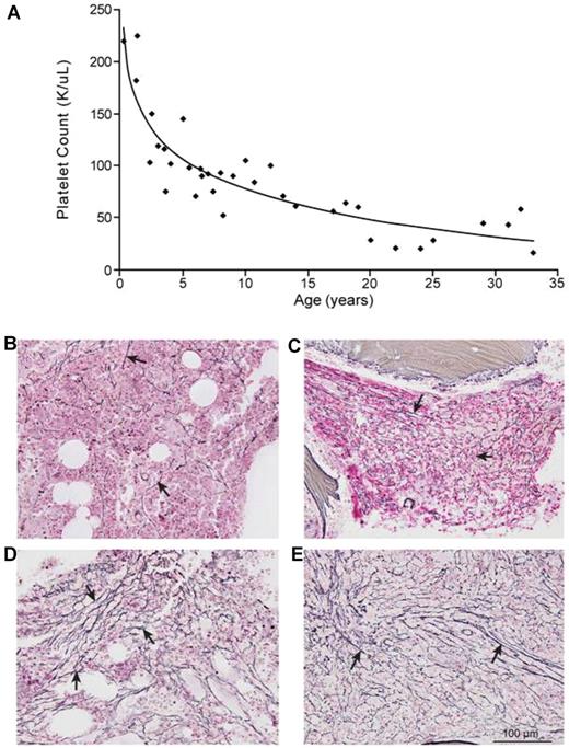 Figure 3. GPS is a progressive disorder. (A) Platelet counts of 14 GPS patients plotted against their age showing a significant negative correlation (y = -42.04 ln(x) + 174.14, R2 = 0.805). Patient 13(II-1), who had splenectomy, is not included. (B) Bone marrow of patient 8 (II-1) at age 10 showing mild (grade 1) reticulin fibrosis (arrows). (C) Bone marrow of patient 8 (II-1) at age 29 showing grade 2–3 reticulin fibrosis (arrows). (D) Bone marrow of patient 13(II-1) at age 47 showing grade 3 reticulin fibrosis (arrows). (E) Bone marrow of patient 4(IV-2) showing grade 3 reticulin fibrosis (arrows). Olympus BX-51 microscope (Olympus America, Melville, NY) equipped with a UPlanFL 20×/0.50 numeric aperture objective. Images were captured using an Olympus DP70 digital camera system. Imaging software was Adobe Photoshop CS3 (Adobe Systems); magnification 200×, all images.