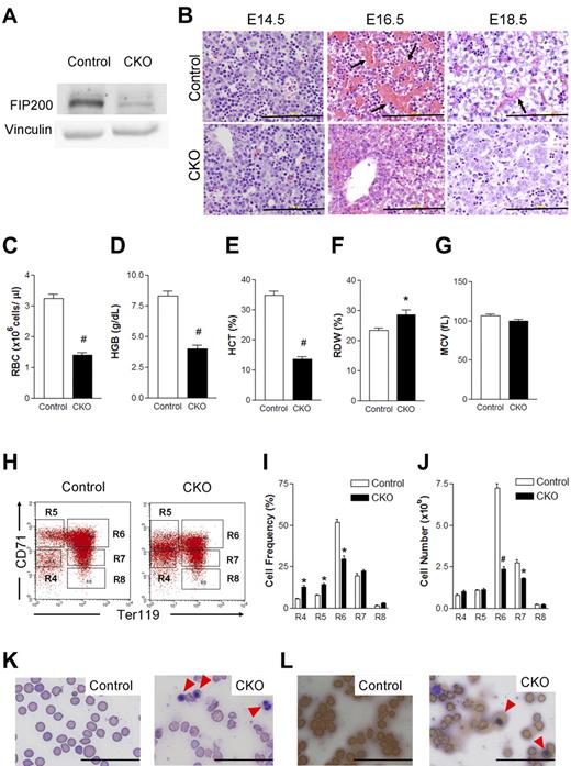 Figure 1. Conditional deletion of FIP200 by Tie2-Cre causes severe anemia in developing embryos. (A) Lysates were prepared from E14.5 liver of control or CKO mice and analyzed by Western blotting using anti-FIP200 (top) or anti-vinculin (bottom) antibodies. (B) H&E staining of E14.5, E16.5, E18.5 fetal livers from control and CKO mice. Arrows indicate the enucleated RBCs. Scale bars, 200 μm. (C-G) RBC parameters of peripheral blood from E18.5 control and CKO mice: RBC numbers (C), hemoglobin (D), hematocrit (E), RBC distribution width (F), and mean corpuscular volume (G). n = 7-17, #P < .01, *P < .05. Data are mean ± SE. (H) Representative fluorescence-activated cell sorting (FACS) profile of erythroid maturation in E14.5 fetal liver of control and CKO embryos. The cells were double-labeled with anti-CD71 and anti-TER119 antibodies. Regions R4 to R8 are defined by characteristic staining pattern of cells, including CD71medTER119−, CD71highTER119−, CD71highTER119+, CD71medTER119+, and CD71lowTER119+, respectively. (I-J) The cell frequency (I) and number (J) of R4-R8 population. Note that there were increased immature population (R4 and R5) and decreased R6 in CKO. n = 5-8, *P < .05, #P < .01. Data are mean ± SE. (K) Wright-Giemsa staining of the blood smears from E18.5 control and CKO embryos. The arrowheads indicate the erythroblasts. (L) Benzidine staining of the blood smears as in panel K. Arrowheads indicate the positively stained erythroblasts. Scale bars, 100 μm.