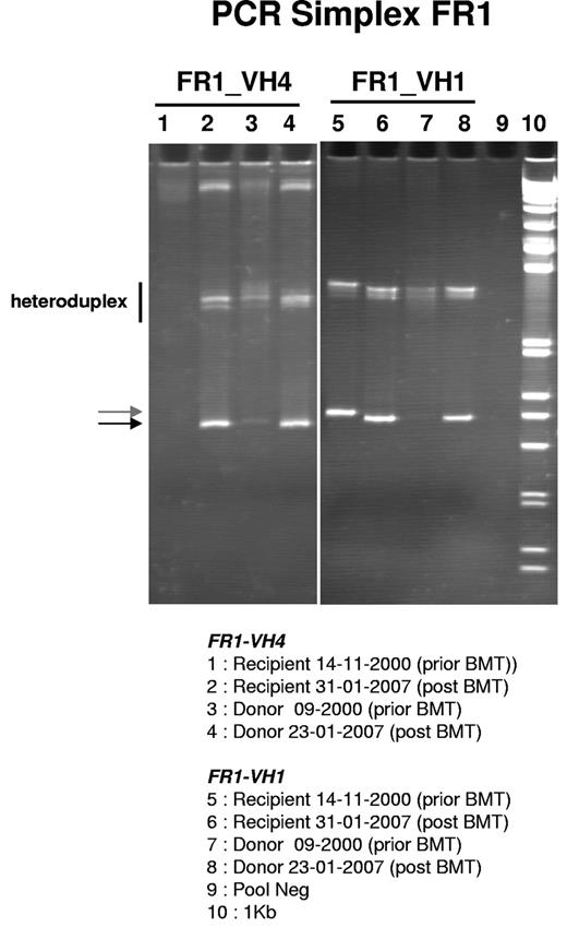 Figure 1. PCR analysis of IGHV-D-J rearrangements using FR1 Biomed-2 primers. Samples as indicated. Arrows indicate clonal rearrangements. Vertical black bar indicates the position of heteroduplexes.