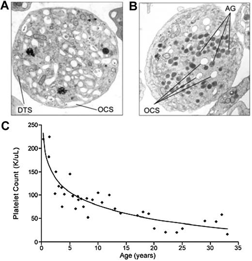 Electron micrograph of a platelet from (A) a patient with GPS compared with (B) a normal control. (C) Progressive thrombocytopenia of GPS. See complete Figures 2 and 3 in the article beginning on page 4990.