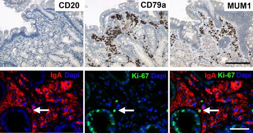 Figure 6. Detection of IgA+ plasmablasts and plasma cells, but not CD20+ cells within human mucosal biopsies during RTX treatment. Three patients with diffuse large B-cell lymphoma were treated with RTX plus cyclophosphamide, hydroxydaunomycin, Oncovin, prednisone, and control biopsies were taken after 3 months from the duodenum or stomach. A representative duodenal biopsy is shown with absence of CD20+ B cells, whereas numerous CD79a, MUM1, and IgA+ cells were detected. Virtually all cells that were stained by these markers showed plasma cell morphology, including IgA+/Ki67+ plasmablasts detectable at a low frequency (white arrow). Original magnifications, ×200 (top) and ×400 (bottom). Black bar indicates 100 μm; white bar, 50 μm. Microscope was Olympus AX70 and AxioImager Z1 (Zeiss); numeric aperture of objective lenses were ×20, 0.70 mm; ×40, 0.90 mm. Stains used were immunoperoxide, Alexa Fluor 488/555, and DAPI (4′-6′-diamidine-2-phenylindole). Camera used was JVC KY-F70 and CCD camera (AxioCam MRm; Zeiss); acquisition software was DISKUS and Axiovision (Zeiss); and software used for image processing was Adobe Photoshop 7.0 (Adobe Systems).