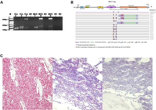 Figure 1. (A) Representative results of the PCR products (355 bp and 120 bp) using DNA of highly purified CD5+/CD19+ CLL tumor cells (2,4,7) and MCC2 (7,9) with LTmutAS2 PCR. The 355 bp bands represent MCPyV wild-type and the 120 bp bands represent mutated MCPyV containing the 246 bp deletion. M, molecular weight marker (50 bp); NC, water control. The numbers indicate the cases as presented in Table 1. Note that the additional 150 bp band in CLL4 and MCC9 has been sequenced and is of nonviral, human genomic origin. (B) Summary of all the sequence data of the LTmutAS2 PCR of 18 MCPyV positive CLL cases according to Shuda et al.7 Although MCPyV positive in the VP1 PCR case number 19 did not show any amplification using the LTmutAS2 PCR and thus is not part of this figure. Single nucleotide mutations are indicated in diverse colors. (C) Left: As positive control a previously MCPyV tested MCC was used revealing specific nuclear staining (red) in the MCC cells.13,14 (Middle) The nodular neoplastic CLL infiltrates within the 2 available corresponding bone marrow trephines revealed specific nuclear expression of the LTAg by IHC (red) whereas nonmalignant hematopoetic cells are MCPyV negative. One of the 2 is cases is shown. (Right) As negative control for MCPyV LTAg IHC the primary antibody (CM2B4) was omitted and no nuclear or cytoplasmic staining was found.