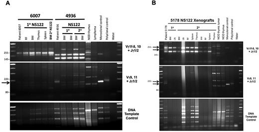 Figure 3. Polymerase chain reaction (PCR)-based analyses of TCRG gene rearrangement reveal loss of patient T-ALL clones in NS122 xenografts associated with T-ALL immunophenotype change. (A) PCR analysis of TCRG gene rearrangement was performed on T-ALL 6007, which maintained the same immunophenotype in NS122 xenografts (lanes 2-7) and T-ALL 4936 (lanes 8-12), which exhibited immunophenotype change from less than 5% CD1a+ cells in the patient sample to more than 95% CD1a+ cells in xenografts. DNA from NOD thymus and NS endogenous lymphoid tumor (lymphoma) were used to detect amplified products from murine TCR rearrangement. Monoclonal and polyclonal DNA templates provided by the manufacturer and water were used as controls. The arrow indicates a Vγ9,11+Jγ1/2 PCR product found in the 4936 patient sample (lane 8) not found in primary (lanes 9-10) or secondary (lanes 11-12) NS122 xenografts. RF, right femur; BM, bone marrow. (B) T-ALL 5178 patient sample had 5% CD5+ cells but some NS122 xenografts had more than 90% CD5+ cells. PCR analysis of TCRG rearrangement was performed on the patient sample (lane 2), 1 primary (lanes 3-4), and 2 secondary (lanes 5-13) NS122 xenografts that had greater than 90% CD5+ cells. The arrows indicate Vγ1f-8,10+Jγ1/2 and Vγ9,11+Jγ1/2 PCR products found in the patient T-ALL sample not found in the primary and secondary NS122 xenografts. RF, right femur; BM, bone marrow; LN, lymph node.