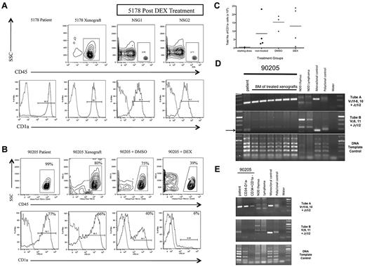 Figure 7. CD1a− T-ALL cells from poor outcome T-ALL are DEX-resistant. (A) T-ALL (5178) was a diagnostic sample from a patient who did not experience clinical relapse. NSG mice were injected intrafemorally with 5 × 105 5178 T-ALL cells in the RF. Engraftment was confirmed 12 weeks later by left femur BM aspirate showing more than 25% human CD45+ cells. NSG recipients were treated with DEX or DSMO vehicle daily for 14 days. Flow cytometric analysis of BM cells recovered 1 week after completion of treatment was performed. Panels show human CD45+ cells from xenografts (top row contour plots) coexpressing CD1a (bottom row histograms). Light gray outline in histograms represents isotype control, dark gray outline represents T-ALL sample stained with PE-conjugated anti-CD1a antibody. T-ALL 5178 engrafted well in NSG xenograft (top row, left panel) and DEX treatment resulted in elimination of most leukemia cells from treated NSG1 and NSG2 xenografts (top row, middle and right panels). The high percentage of CD1a− cells in the patient sample (bottom row, left panel) was maintained in nontreated (bottom row, middle left panel) and DEX-treated xenografts (bottom row, middle right and right panels). (B) T-ALL 90205 was a diagnostic sample from a patient who later relapsed. NSG mice were injected intrafemorally with 5 × 105 T-ALL cells. Engraftment was confirmed 12 weeks later by left femur BM aspirate showing more than 25% human CD45+ cells. NSG xenografts were treated with DEX or DSMO vehicle daily for 14 days. The mice were killed 1 week after completion of treatment. Flow cytometric analysis of patient and xenograft BM cells recovered 1 week after treatment revealed CD45+ cells (top row contour plots) coexpressing CD1a (bottom row histograms). Light gray outline in histograms represents isotype control, dark gray outline represents T-ALL sample stained with PE-conjugated anti-CD1a antibody. The patient T-ALL had a high percentage of CD1a+ cells (bottom row, left panel) that was maintained in the NSG (bottom row, middle left panel) and DMSO-treated (bottom row, middle right panel) xenografts. The DEX-treated NSG xenograft showed a high percentage of residual leukemia cells (top row, right panel) that did not coexpress CD1a (bottom row, right panel). (C) Flow cytometric analysis was used to determine the percentage of CD1a− cells in patient T-ALL compared with nontreated, DMSO-treated, and DEX-treated NSG xenografts. This was multiplied by the total cell dose to determine the number of CD1a− cells injected into NSG recipients (starting dose) or the total BM cell counts to determine the absolute number of CD1a− cells in nontreated, DMSO-treated, and DEX-treated NSG xenografts. Each dot represents the total number of CD1a− cells from each xenograft, with the bar indicating the mean percentage for each treatment group. The number of CD1a− cells in the BM of DMSO- and DEX-treated xenografts increased compared with nontreated xenografts. (D) PCR-based analysis of TCRG gene rearrangements of patient 90205 T-ALL compared with DEX-treated T-ALL NSG xenografts. The arrow indicates Vγ9,11+Jγ1/2 PCR product found in the 90205 patient sample that was not found in the treated recipients. (E) PCR-based analysis of TCRG gene rearrangement of 90205 patient T-ALL compared with sorted 90 205 CD34−CD1a− and CD34+CD1a− subsets, revealing PCR products of identical size in the CD1a− subsets with the patient sample.