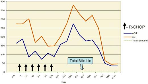 Grade III elevation of transaminases following 6 cycles of R-CHOP for advanced grade III follicular lymphoma in a patient treated at the University of Alabama at Birmingham with chronic HCV infection and elevated HCV viral load (> 107 copies/mL). The albumin and bilirubin remained normal throughout therapy. The patient did not receive further antiviral therapy and the transaminases normalized after approximately 2 years.
