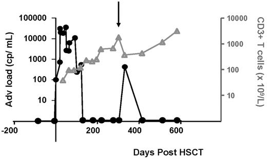 Figure 1. Adenoviral load in relation to T-cell numbers. A 2-year-old girl was treated with unrelated cord blood HSCT for Hurler syndrome (nonmalignant, MPS1). She developed an AdV primo infection or reactivation, which was detectable by AdV qPCR (100 cp/mL) at day 19. Within a period of 4 days the viral load increases by 2 log, and cidofovir is started. There are no signs of disease. Only as CD3 numbers (gray line) are increasing, adenoviral load (black line) goes down. The downward pointing arrow indicates the timing of intensification of therapy with immunosuppressants when the period after HSCT is complicated by steroid refractory autoimmune cytopenia; she receives mycophenolate mofetil 45 mg/kg/d, prednisone 2 mg/kg/d, anti-CD20 therapy, and fludarabine infusions from day 314. When symptoms stabilize, immunosuppressants are tapered over time and can be stopped at day 455 after HSCT. Tapering of immunosuppressants is associated with CD3+ T-cell recovery and clearance of advenoviremia.