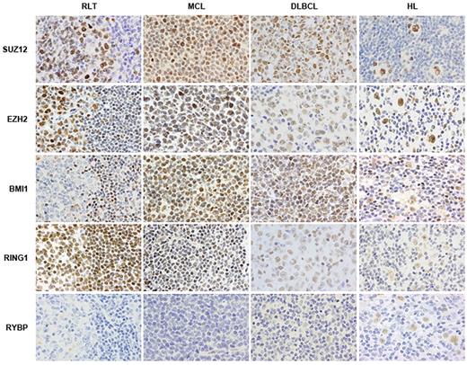 Figure 2. Immunohistochemical staining for PcG members reveals frequent alterations of these proteins in hematologic malignancies. RLT: reactive lymphoid tissue; MCL: mantle cell lymphoma; DLBCL: diffuse large B-cell lymphoma; HL: Hodgkin lymphoma.